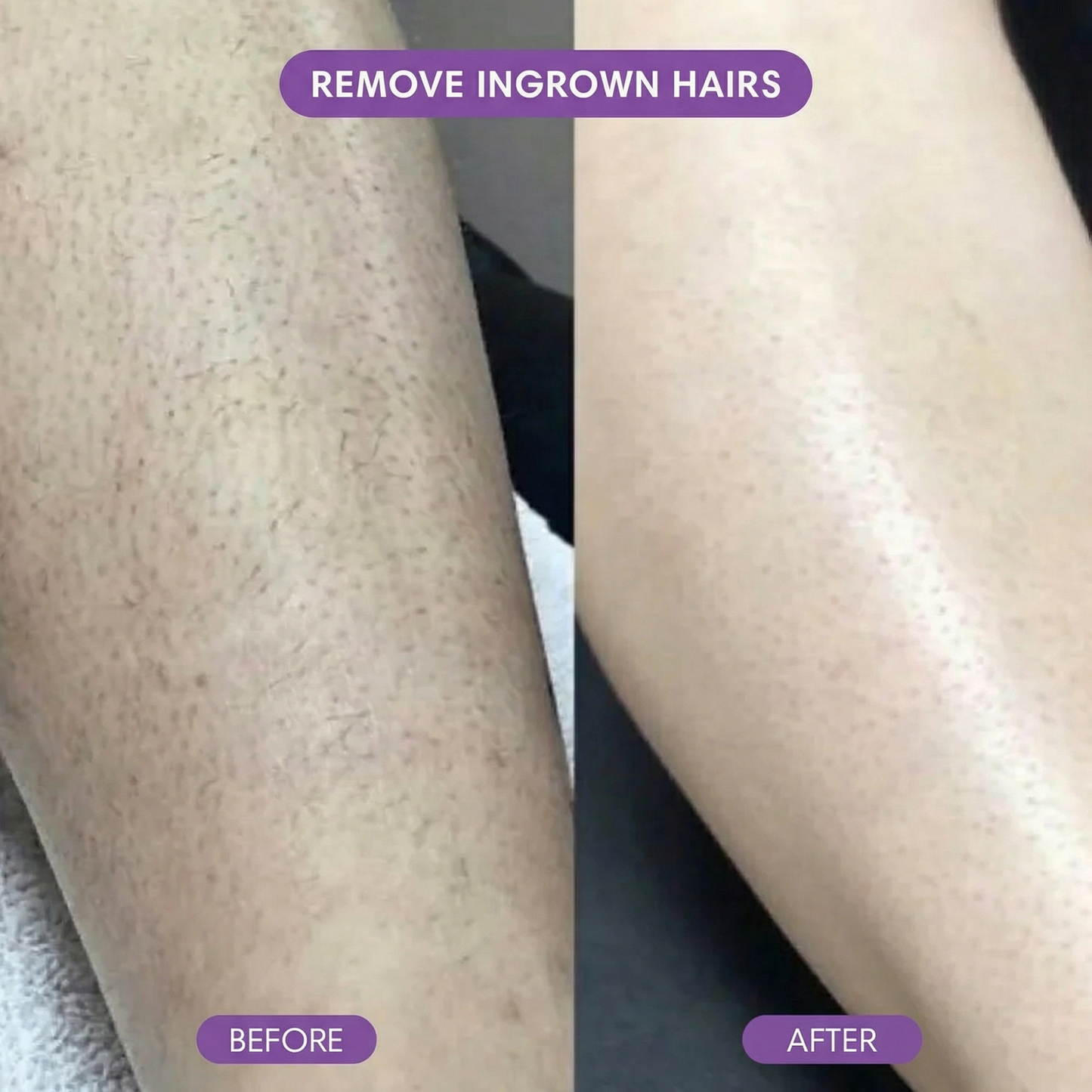 SilkEase™ Hair Removal Set