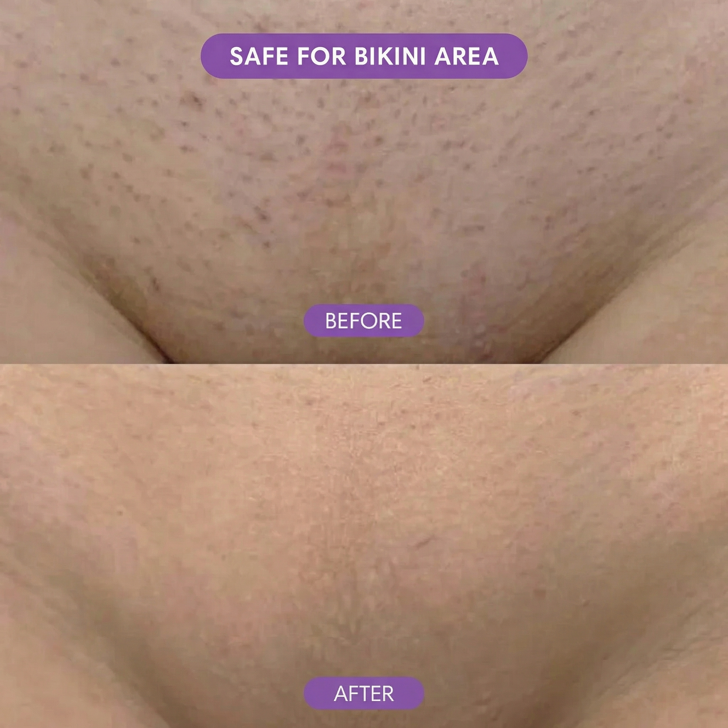 SilkEase™ Hair Removal Set