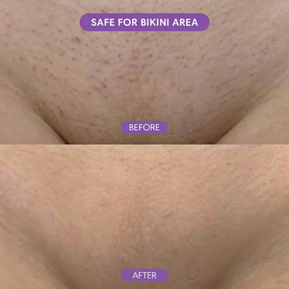 SilkEase™ Hair Removal Set